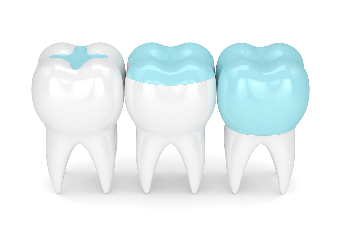 teeth sealants